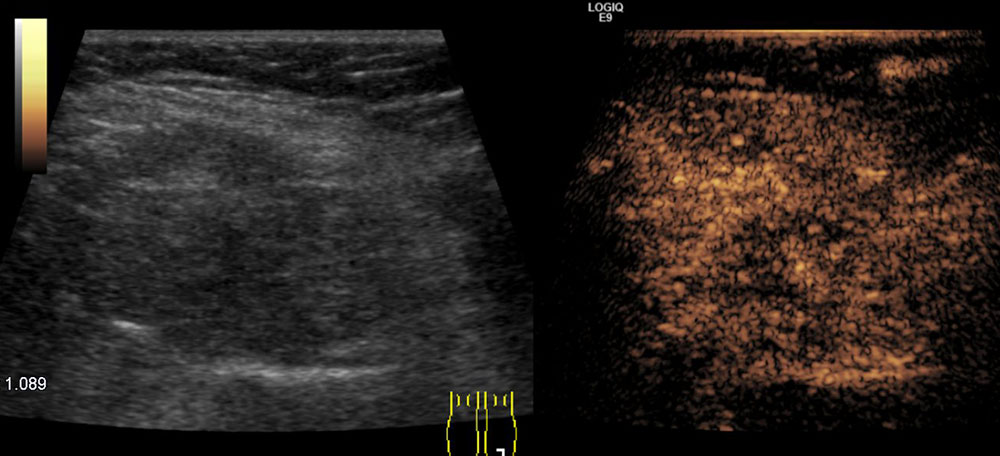 Ultrasound image: FAVA of the calf muscles