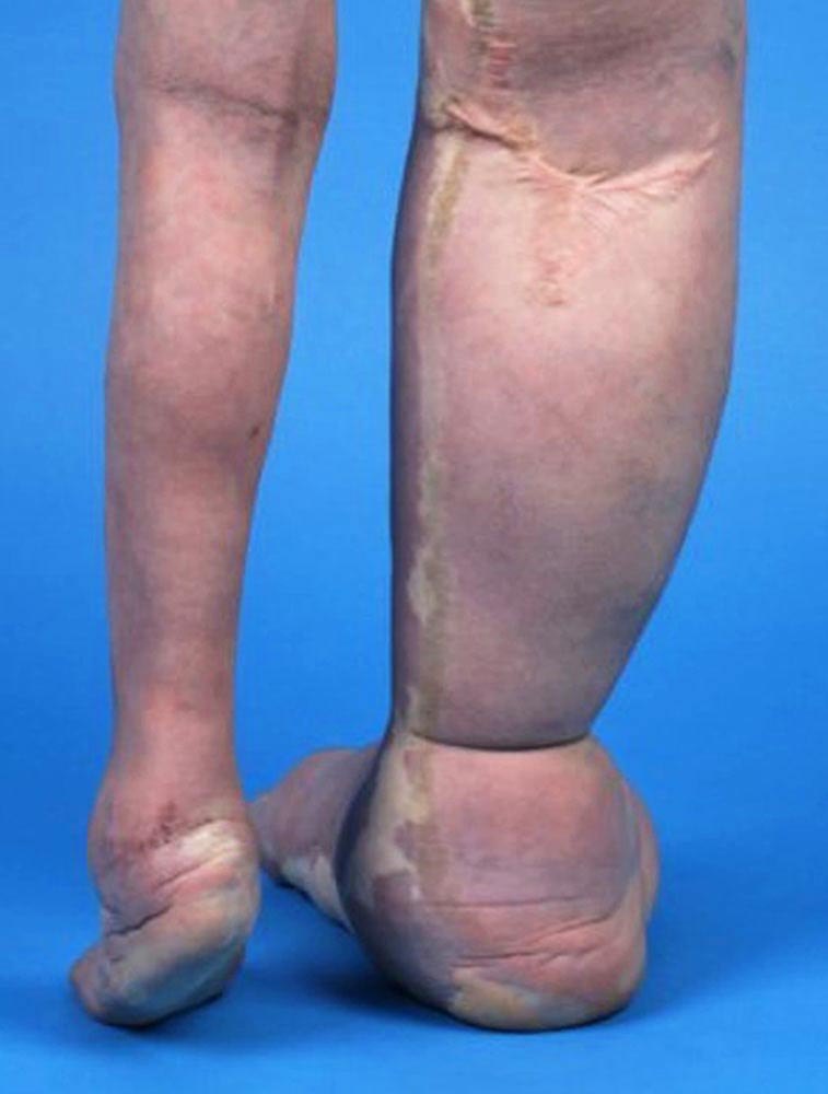 Bilateral capillary malformation in CLOVES syndrome