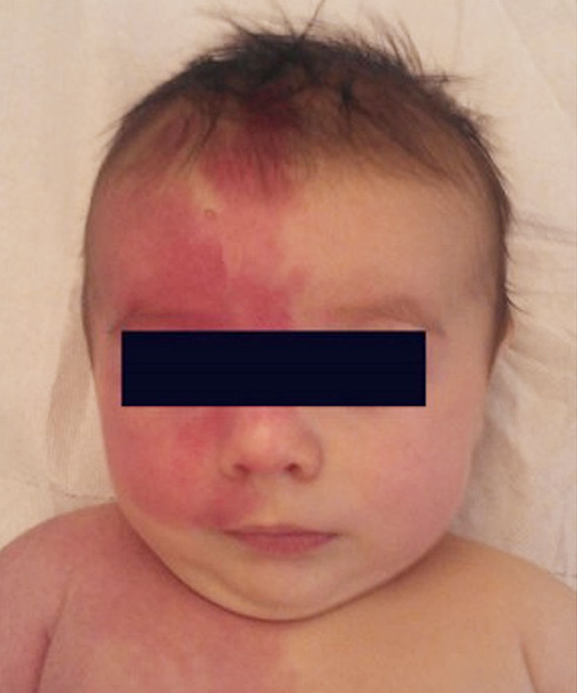 Infant with capillary malformation of the right half of the body