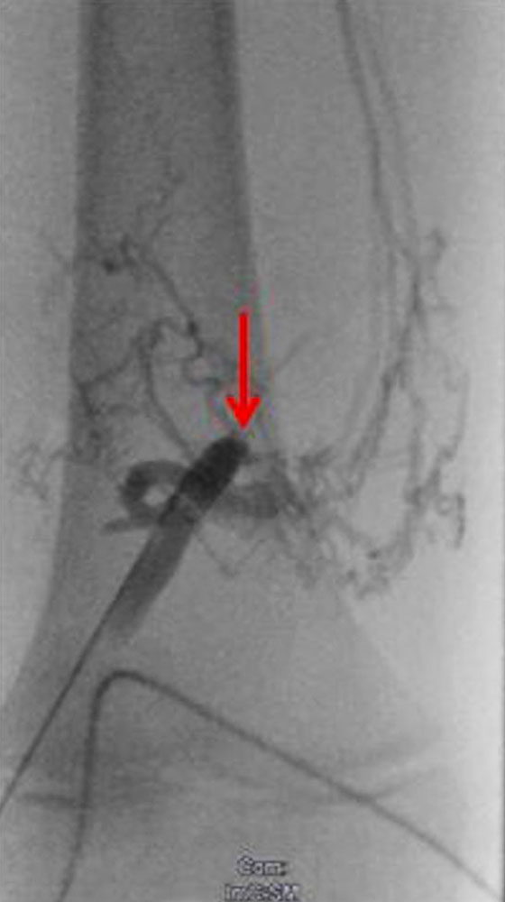 Net-like recurrence of a marginal vein