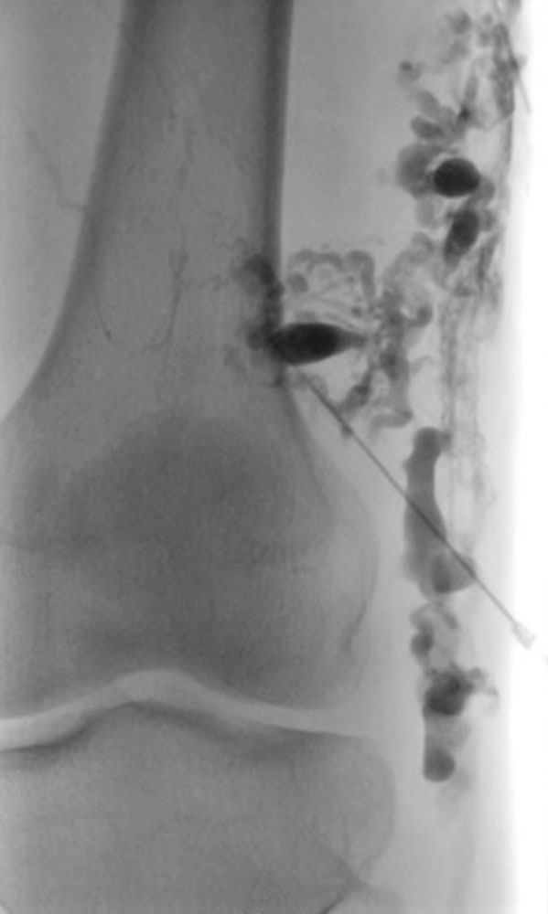 Recurrence of a marginal vein that was completely occluded 7 years ago