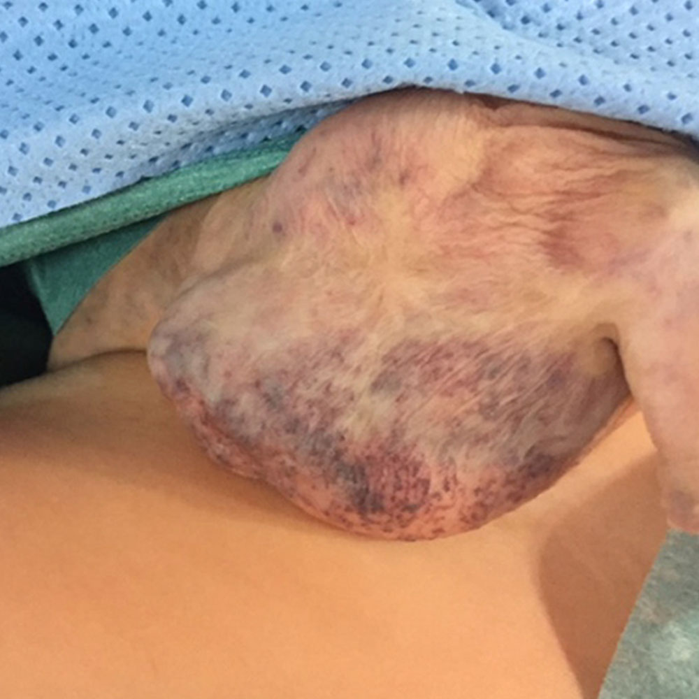 Venous malformation of the scrotum