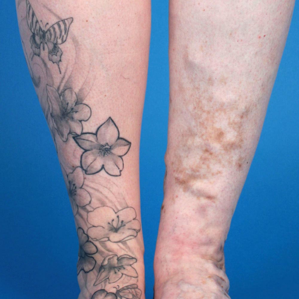 Tattoo on the leg of a patient with an arteriovenous malformation