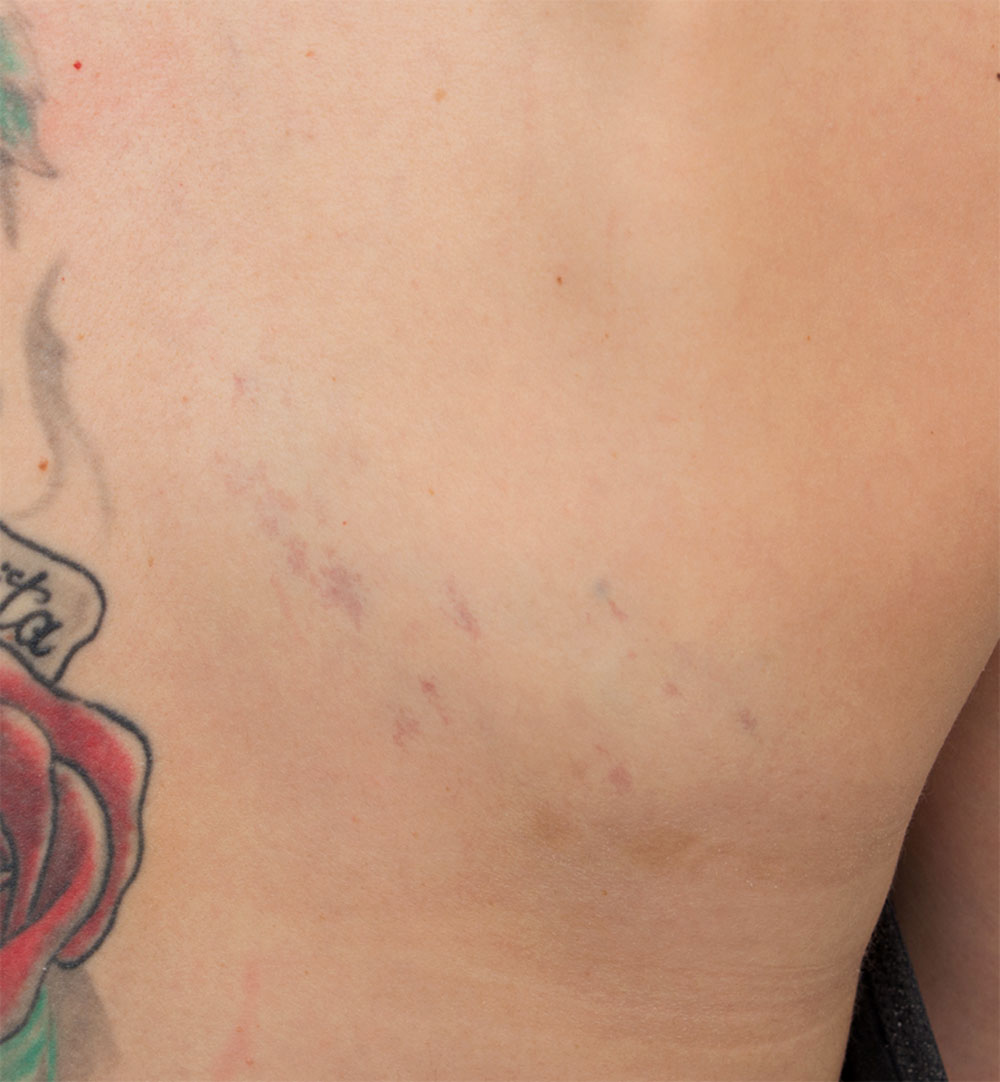 Tattoo here extends close to the area of the venous malformation